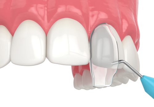 3d render of crooked tooth treatment using bonding procedure