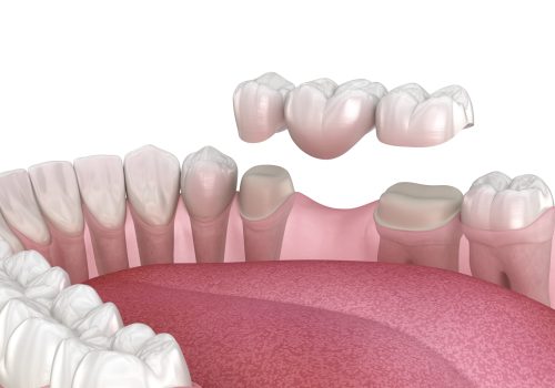 Dental bridge of 3 teeth over molar and premolar. Medically accurate 3D illustration of human teeth treatment