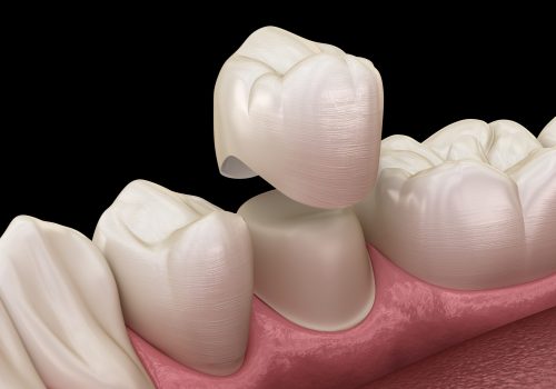 Dental crown premolar tooth assembly process. Medically accurate 3D illustration of human teeth treatment