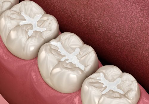 Molar Fissure dental fillings, Medically accurate 3D illustration of dental concept