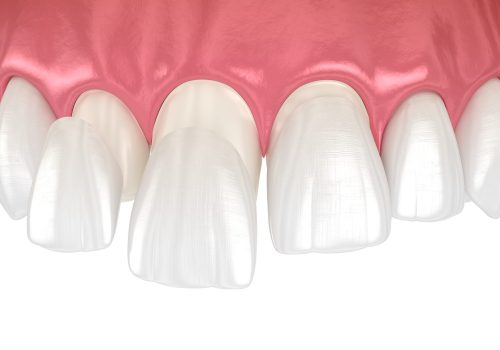 Dental veneers on blue background. 3D illustration