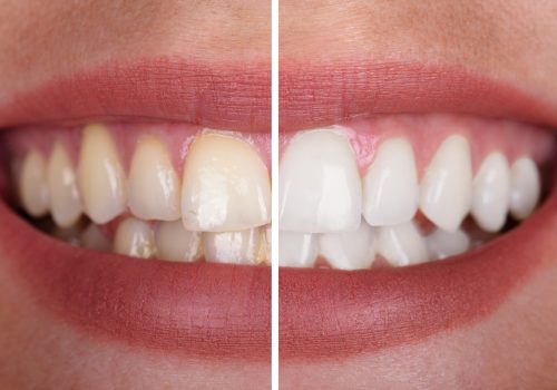 Close-up Of A Smiling Woman's Teeth Before And After Whitening